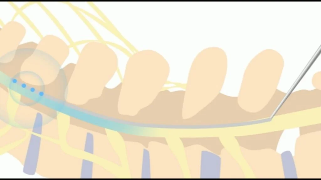 C1–C2 Spinal Schwannoma Surgery